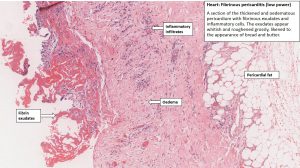 Heart – Pericarditis – NUS Pathweb :: NUS Pathweb