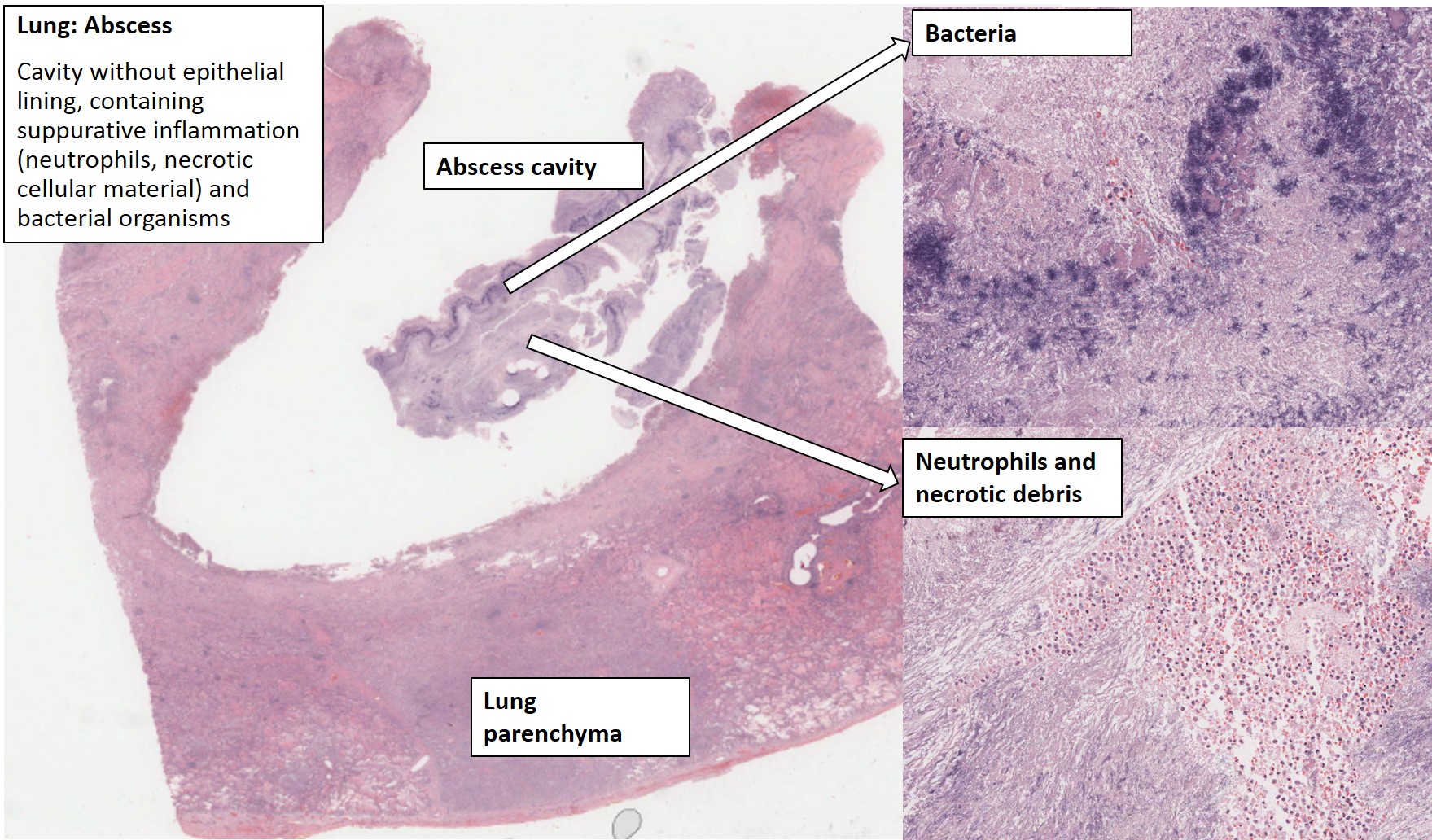Lung Abscess Histology