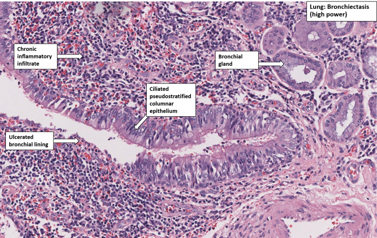 Lung – Bronchiectasis – NUS Pathweb :: NUS Pathweb