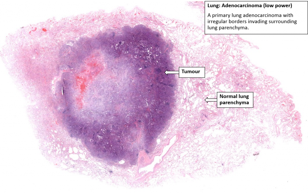 Lung – Adenocarcinoma – NUS Pathweb :: NUS Pathweb