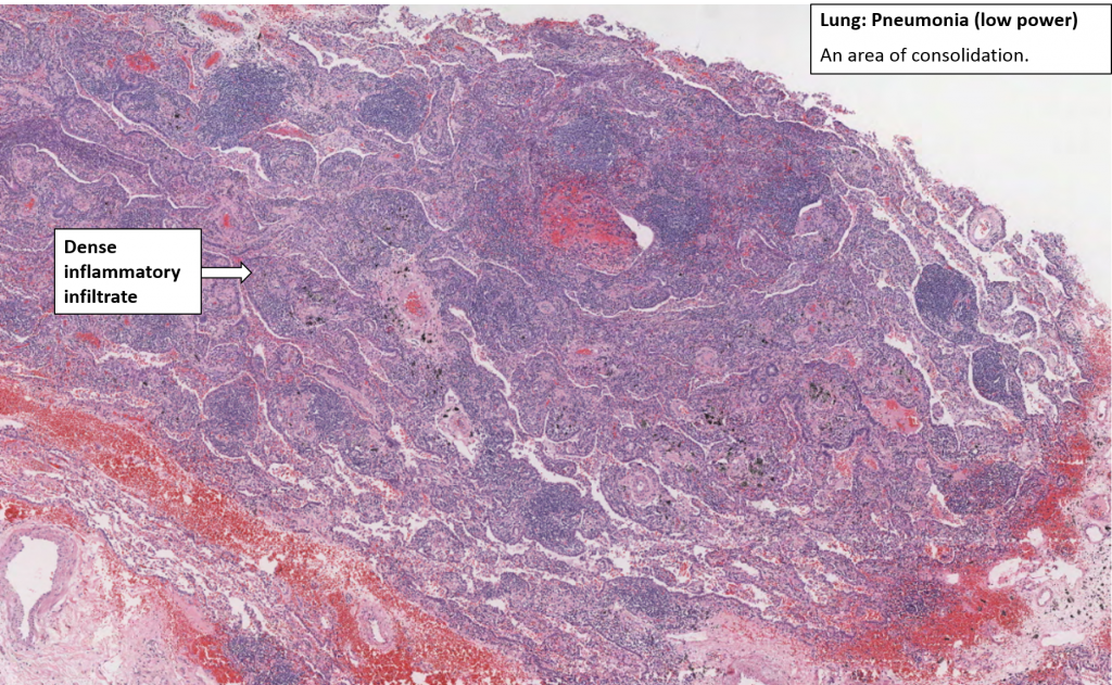 lung-lobar-pneumonia-nus-pathweb-nus-pathweb