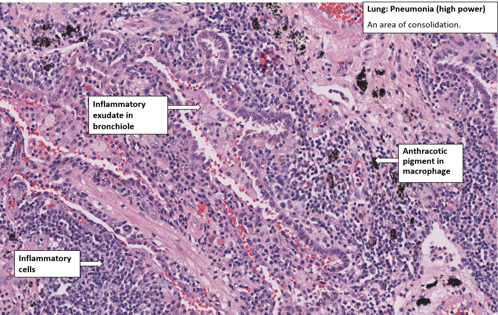 Lung – Bronchopneumonia – NUS Pathweb :: NUS Pathweb