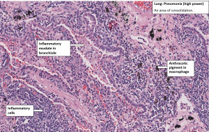 Lung Lobar Pneumonia – NUS Pathweb :: NUS Pathweb