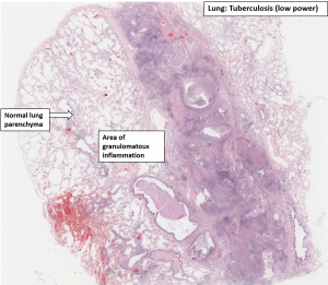 Lung – Tuberculosis – NUS Pathweb :: NUS Pathweb