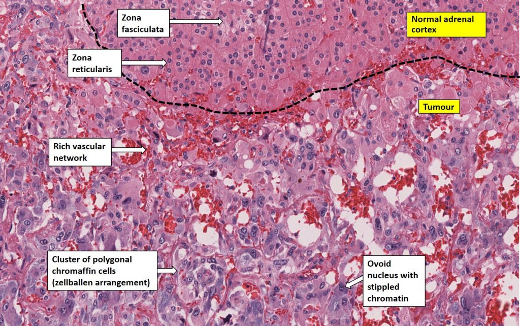 Adrenal – Phaeochromocytoma – NUS Pathweb :: NUS Pathweb