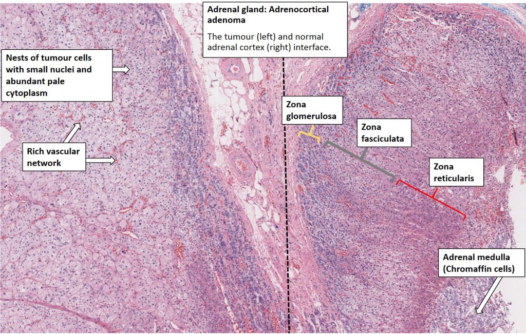 Adrenal – Adrenocortical Adenoma – NUS Pathweb :: NUS Pathweb