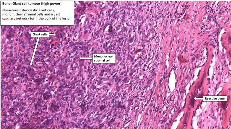 Bone – Giant Cell Tumour – NUS Pathweb :: NUS Pathweb