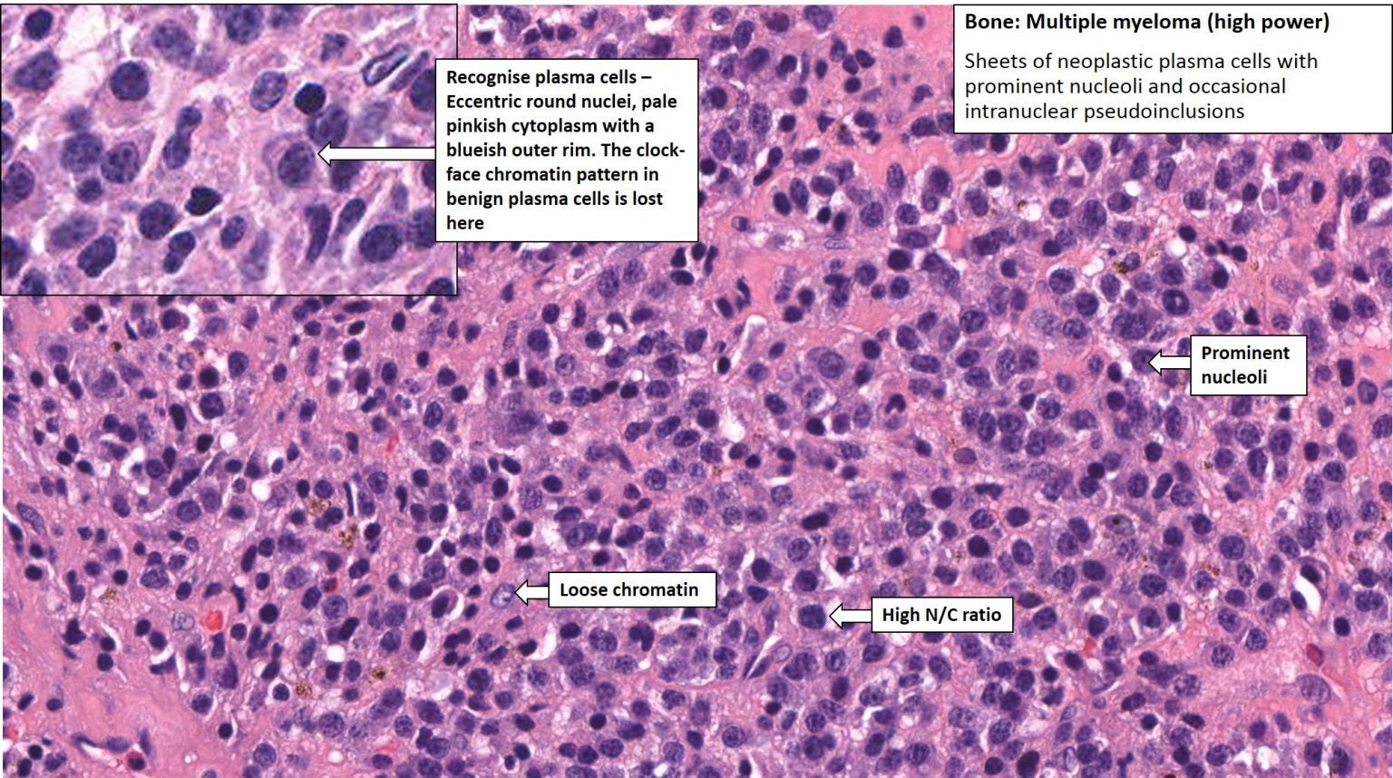 Vertebrae – Myeloma – NUS Pathweb :: NUS Pathweb