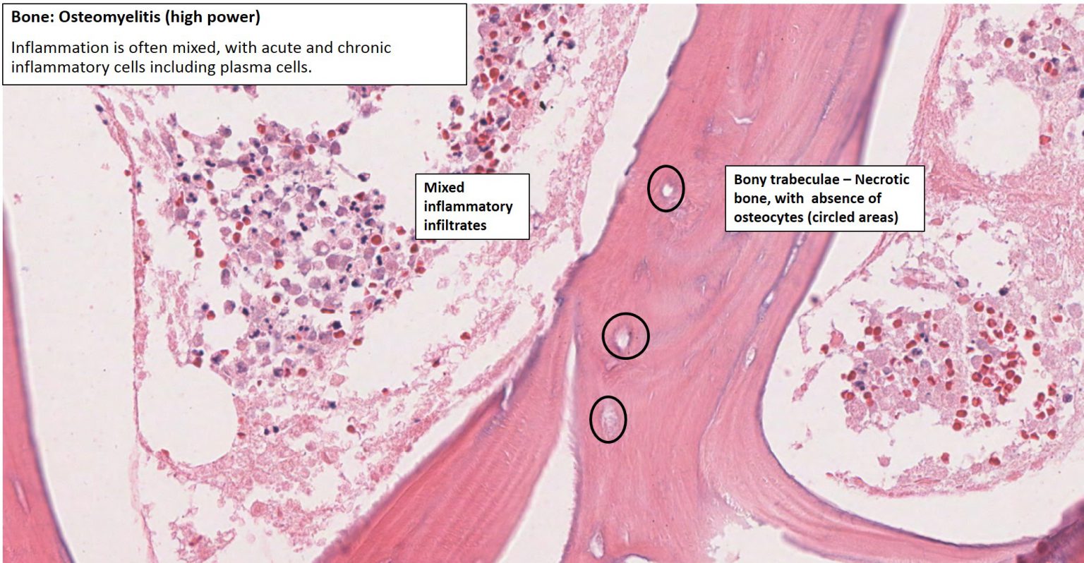 Bone Osteomyelitis Nus Pathweb Nus Pathweb