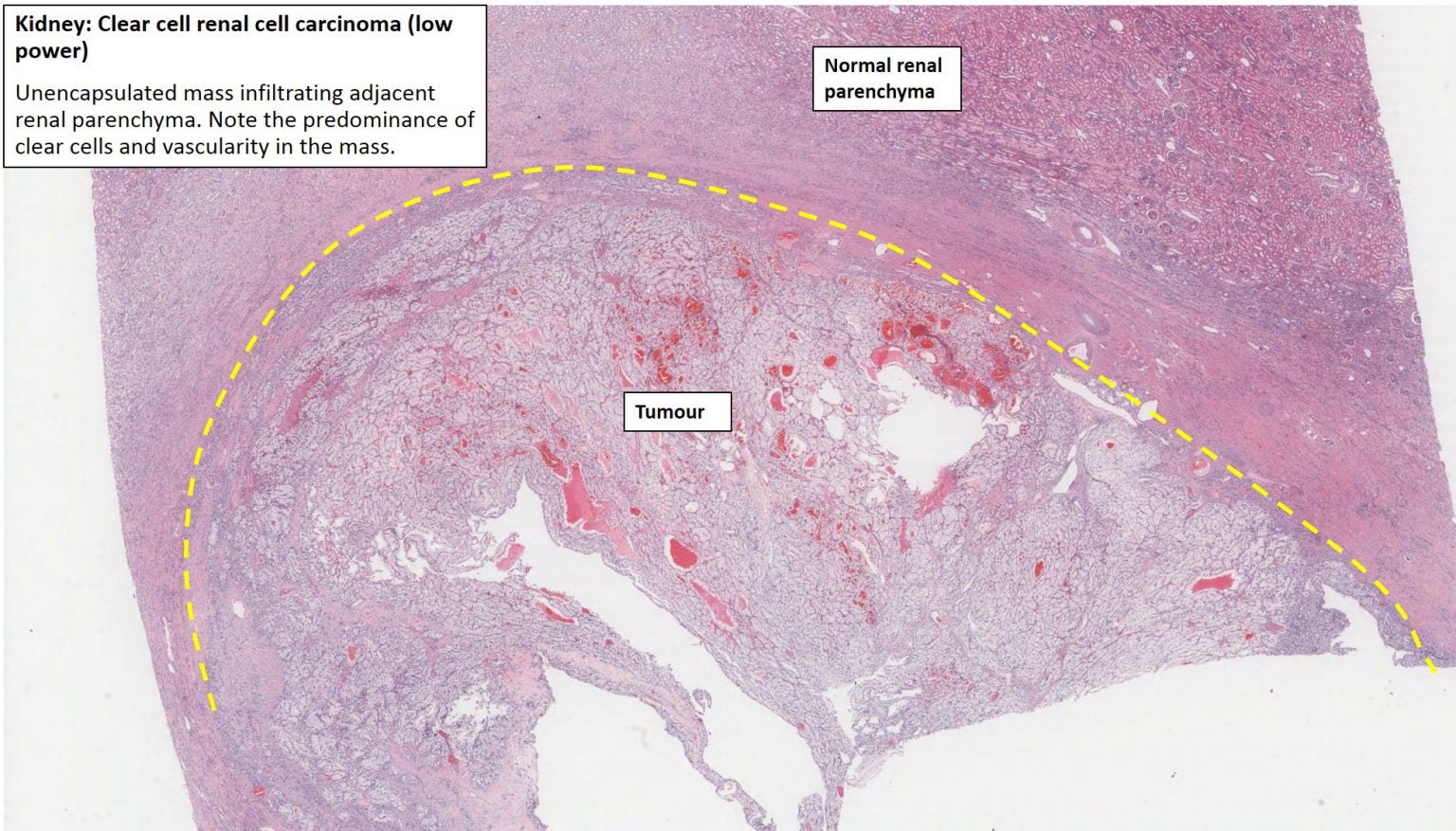 Kidney – Renal Cell Carcinoma – NUS Pathweb :: NUS Pathweb