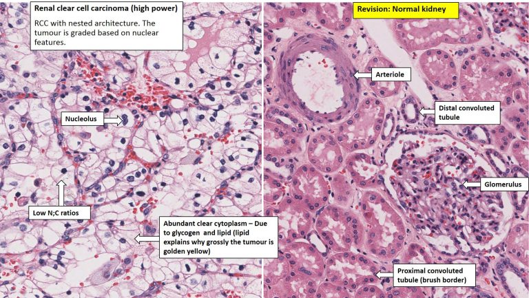 Kidney – Renal Cell Carcinoma – NUS Pathweb :: NUS Pathweb