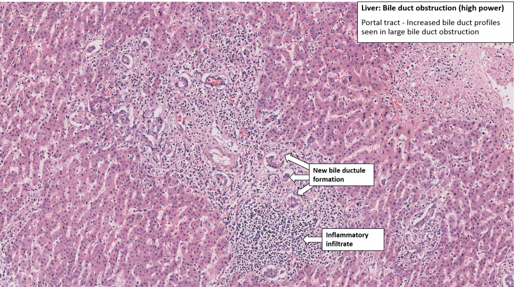 Liver – Choledocholithiasis – Nus Pathweb :: Nus Pathweb