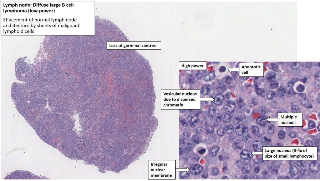 Lymph Node – Large Cell Lymphoma – Nus Pathweb