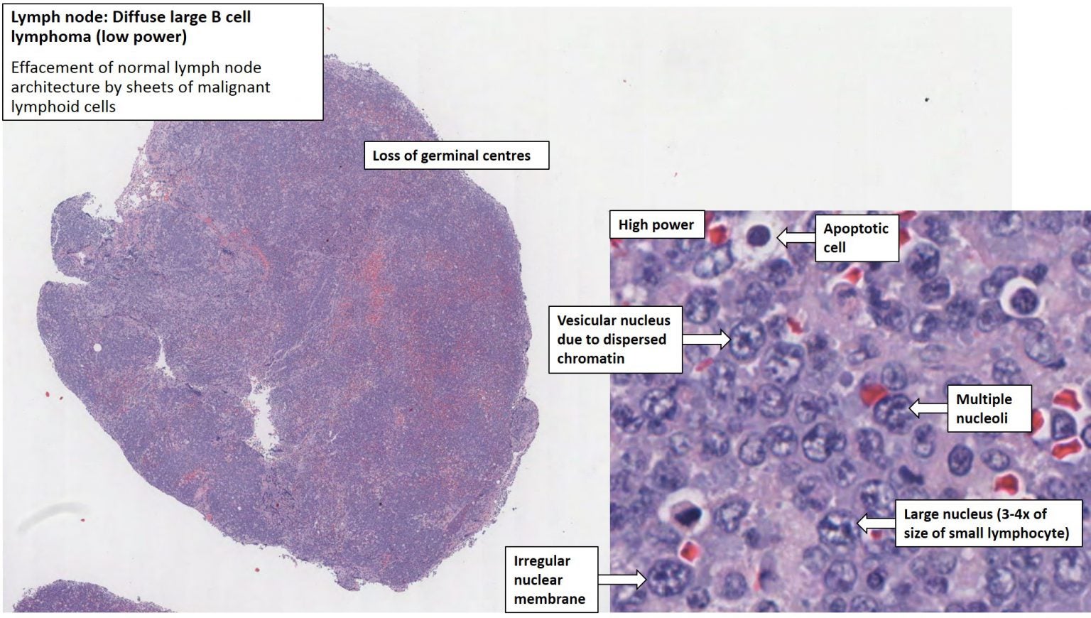 Lymph Node Large Cell Lymphoma Nus Pathweb Nus Pathweb