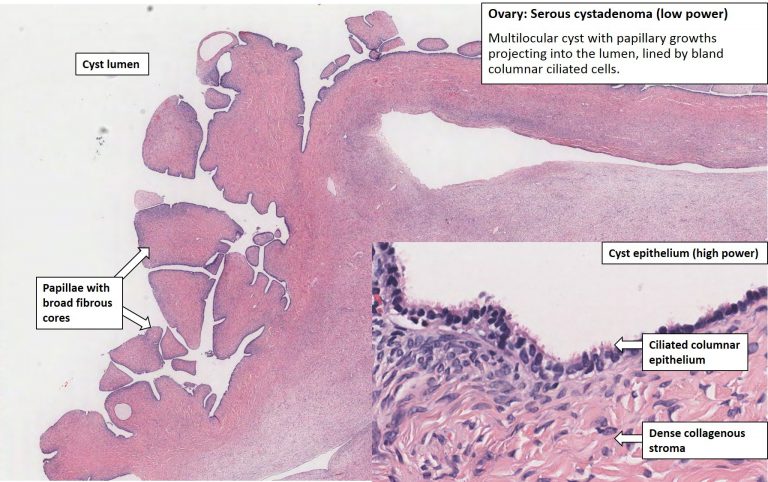 Ovary – Serous Cystadenoma – NUS Pathweb :: NUS Pathweb