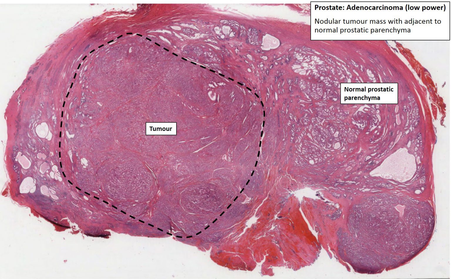 Prostate – Prostatic Carcinoma – NUS Pathweb :: NUS Pathweb