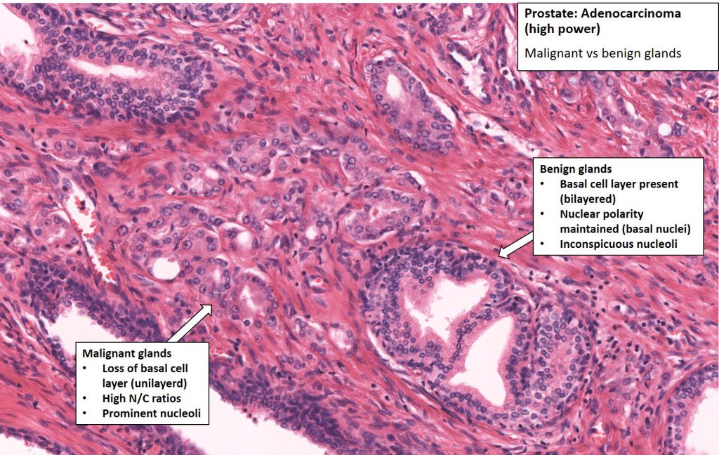 Prostate Prostatic Carcinoma Nus Pathweb Nus Pathweb 4457