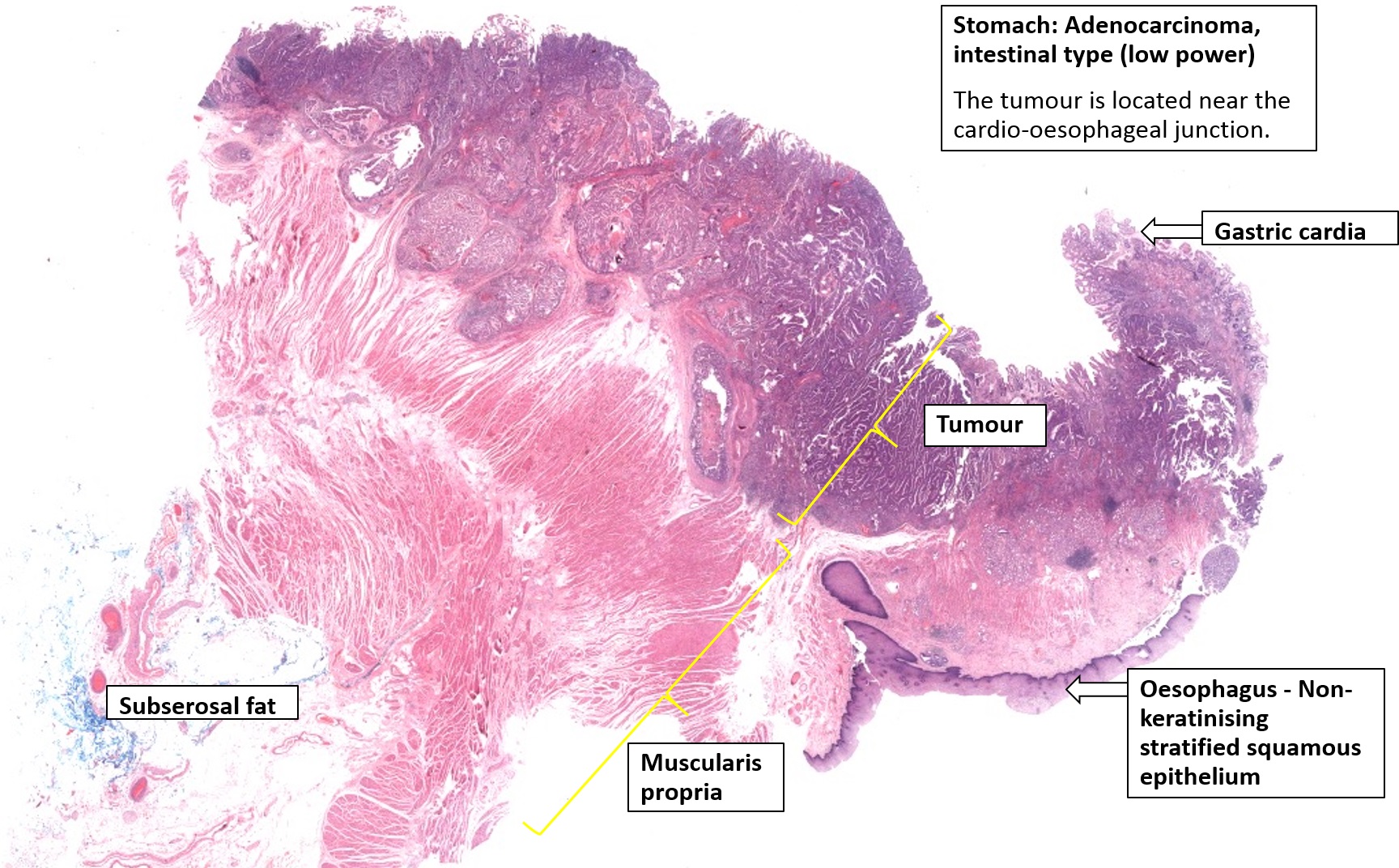 Stomach – Carcinoma – NUS Pathweb :: NUS Pathweb