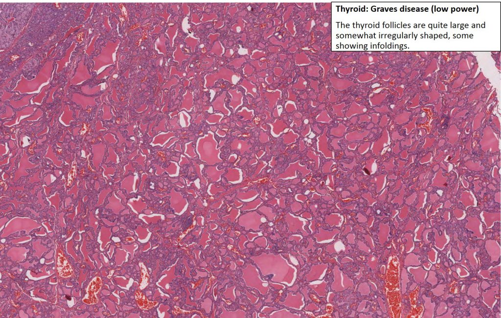 Thyroid – Graves Disease – NUS Pathweb :: NUS Pathweb