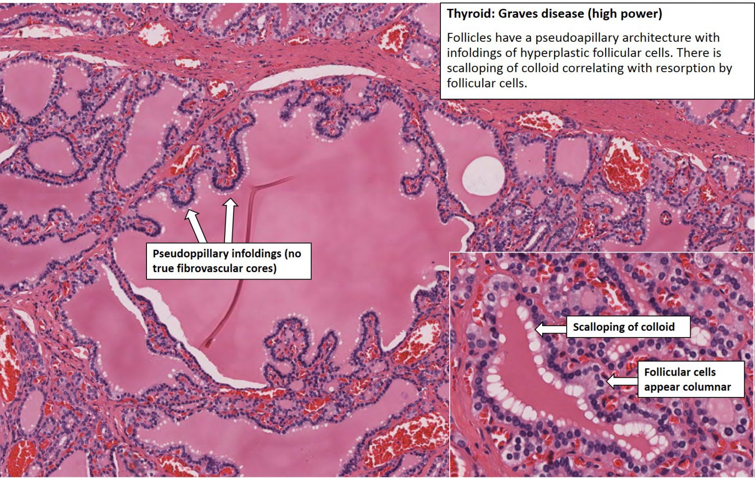 Thyroid – Graves Disease – NUS Pathweb :: NUS Pathweb