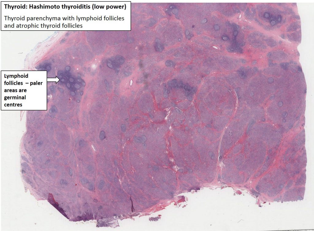 Thyroid – Hashimoto Thyroiditis – NUS Pathweb :: NUS Pathweb