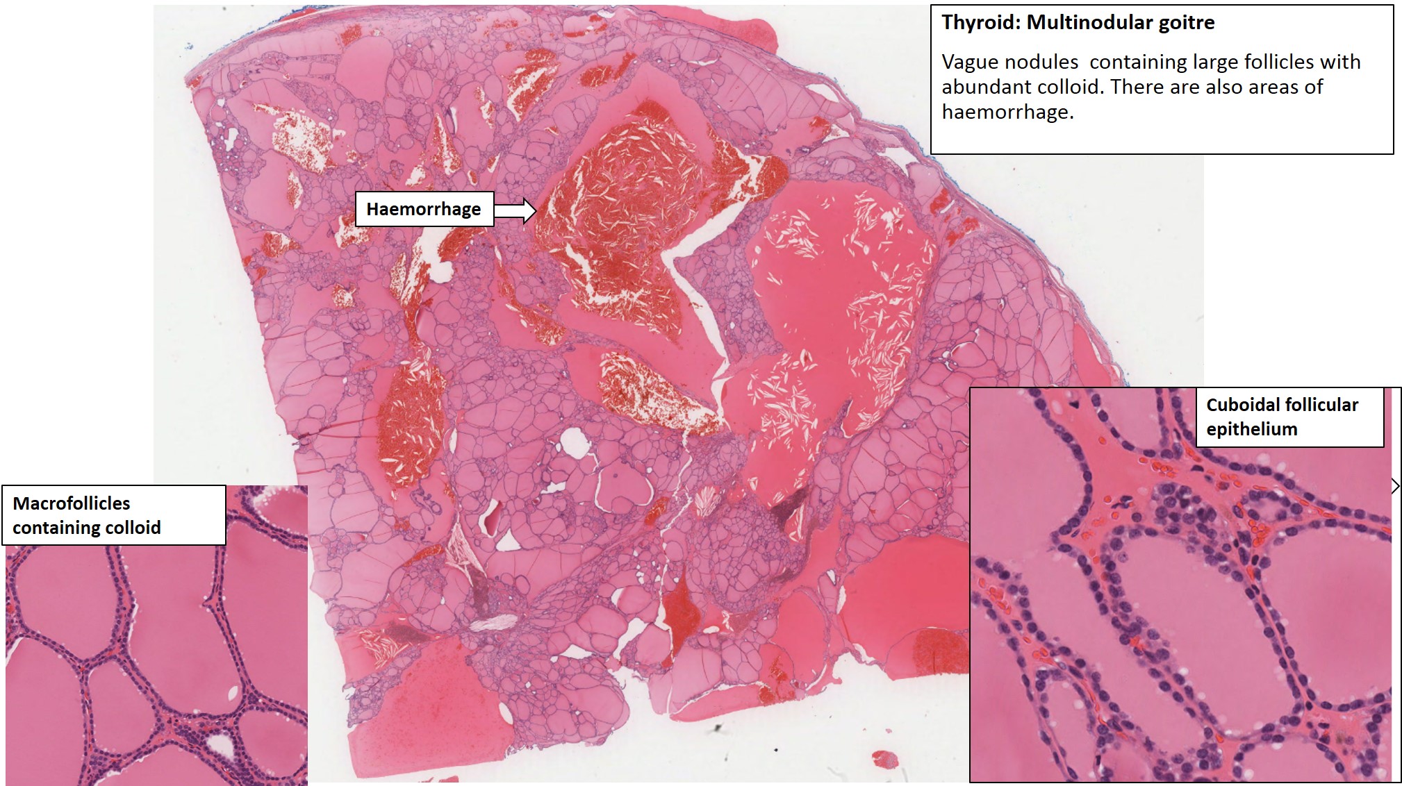 Thyroid – Multinodular Goitre – NUS Pathweb