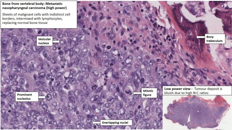 Vertebrae – Metastatic Nasophryngeal Carcinoma – NUS Pathweb :: NUS Pathweb