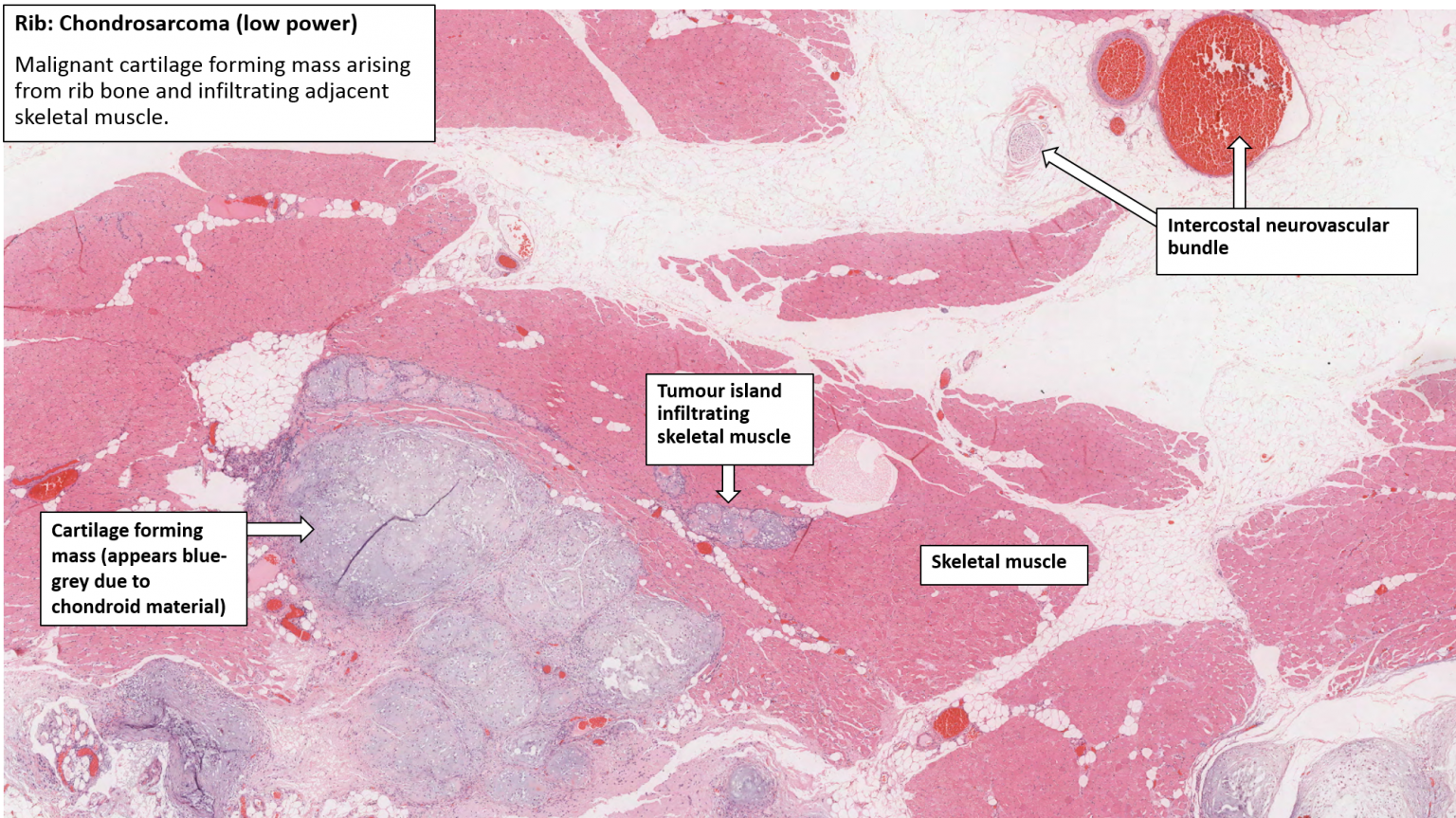 Rib – Chondrosarcoma – NUS Pathweb :: NUS Pathweb