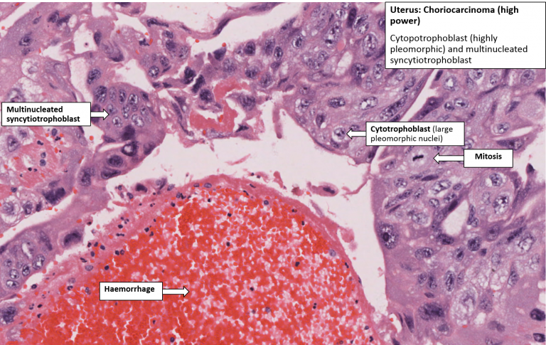 Uterus – Choriocarcinoma – NUS Pathweb :: NUS Pathweb