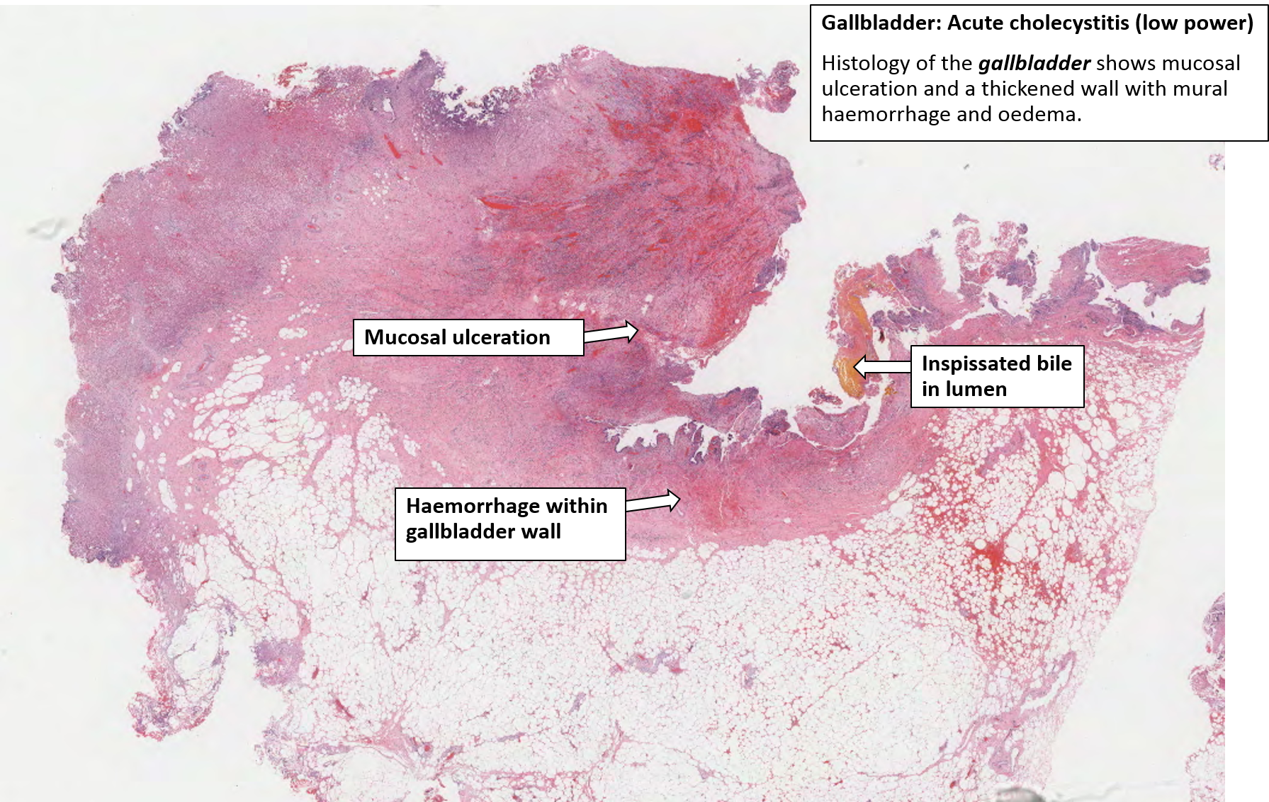 Gallbladder Acute Haemorrhagic Cholecystitis NUS Pathweb NUS Pathweb