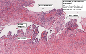 Gallbladder – Acute Haemorrhagic Cholecystitis – NUS Pathweb :: NUS Pathweb