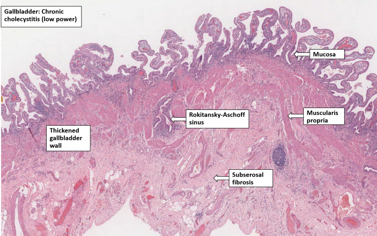 Gallbladder – Chronic cholecystitis – NUS Pathweb :: NUS Pathweb