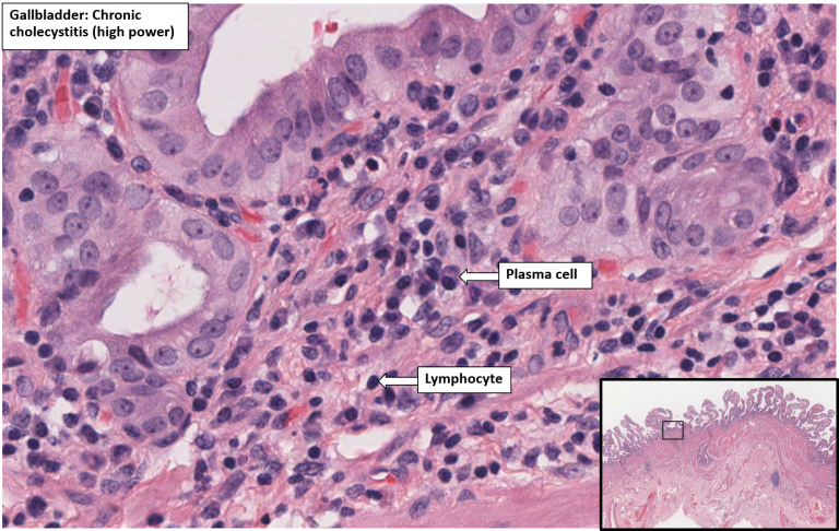 Gallbladder – Chronic cholecystitis – NUS Pathweb :: NUS Pathweb