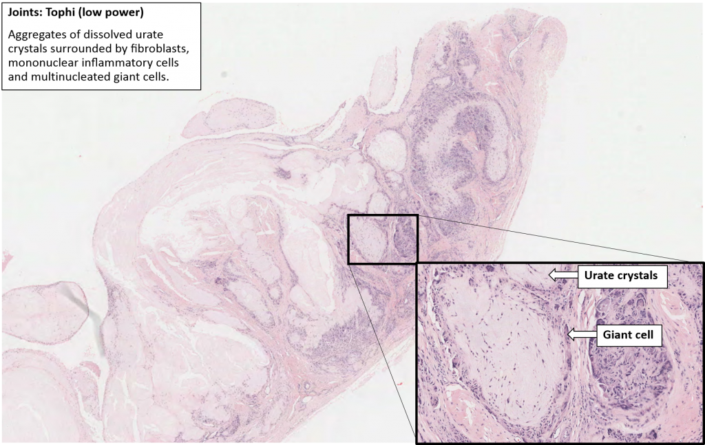 Finger Gout Nus Pathweb Nus Pathweb 