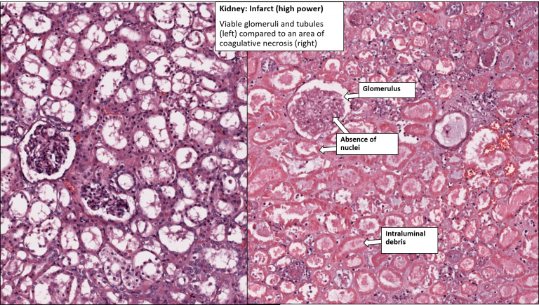 Kidney – Infarct – NUS Pathweb :: NUS Pathweb