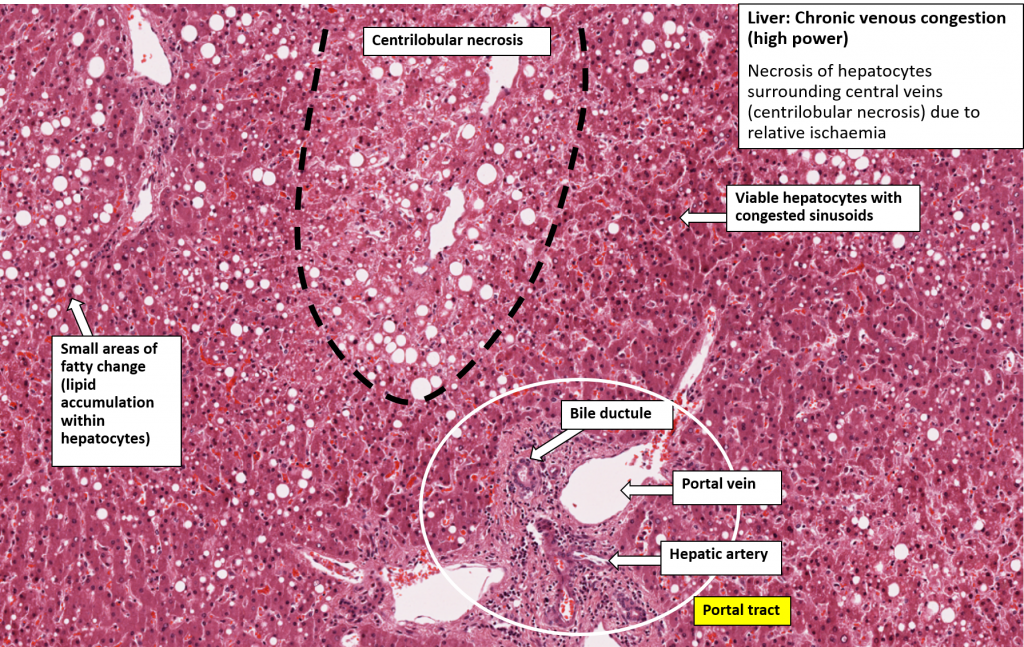 Liver – Chronic Venous Congestion – NUS Pathweb :: NUS Pathweb