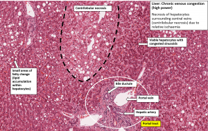 Liver – Chronic Venous Congestion – Nus Pathweb :: Nus Pathweb