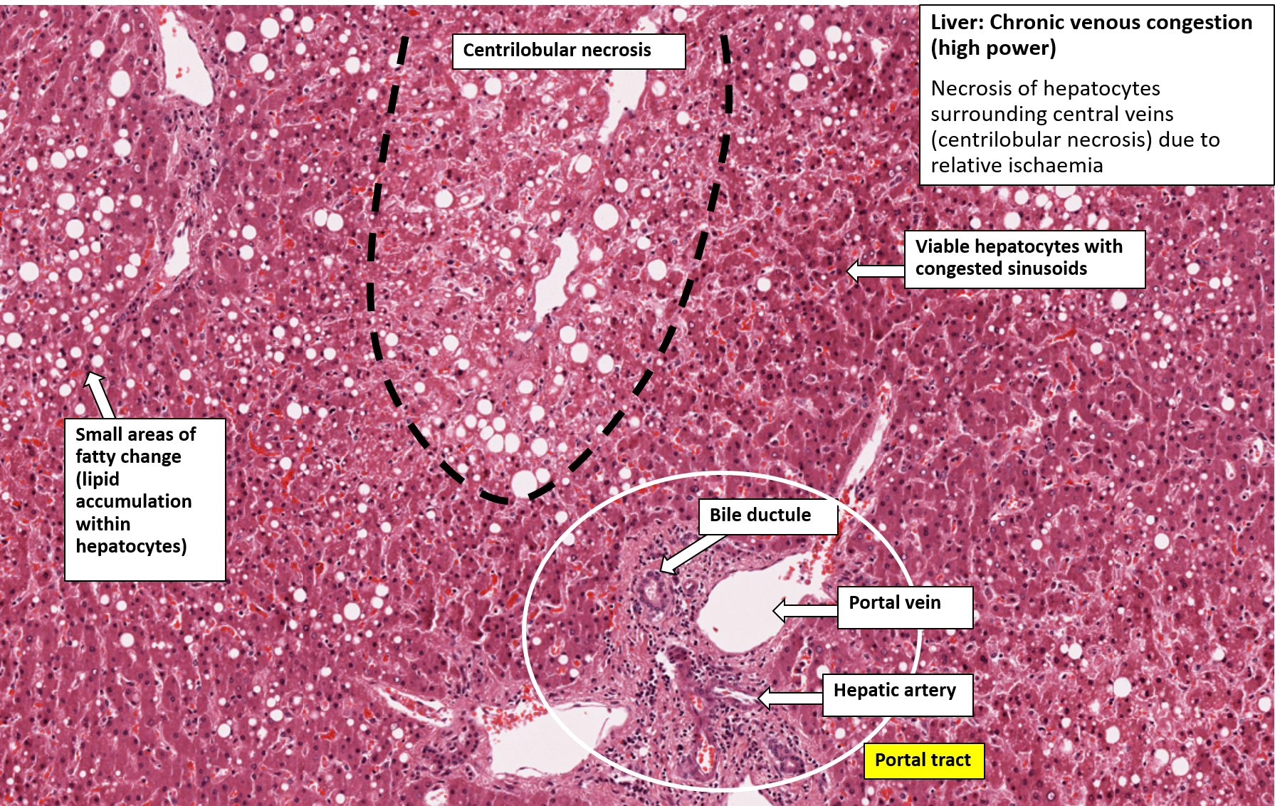 nutmeg liver histology