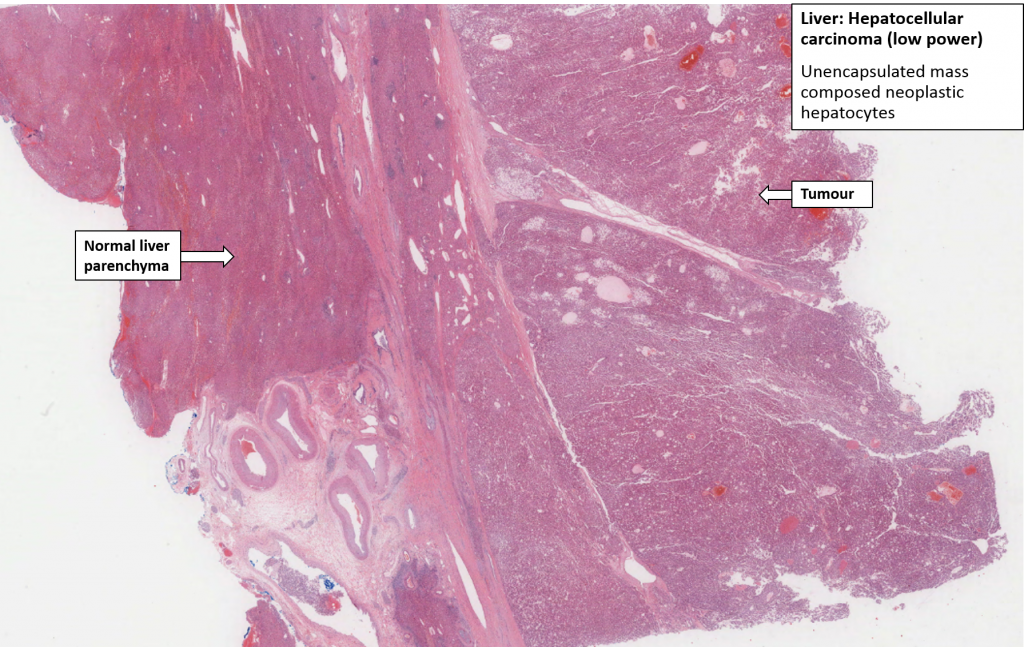 Liver – Hepatocellular Carcinoma – NUS Pathweb :: NUS Pathweb