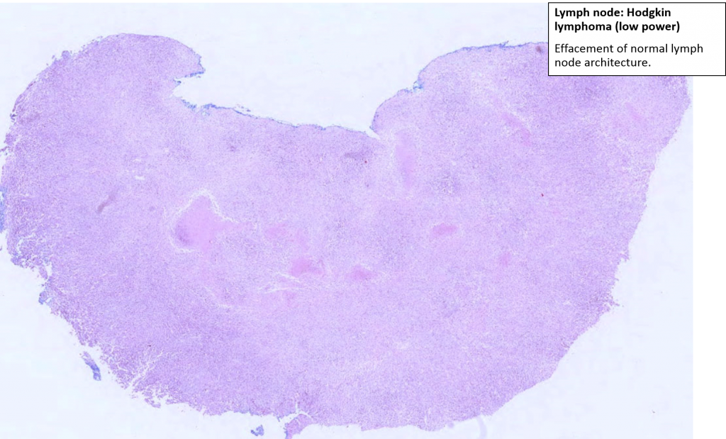 Lymph node – Hodgkin lymphoma – NUS Pathweb :: NUS Pathweb