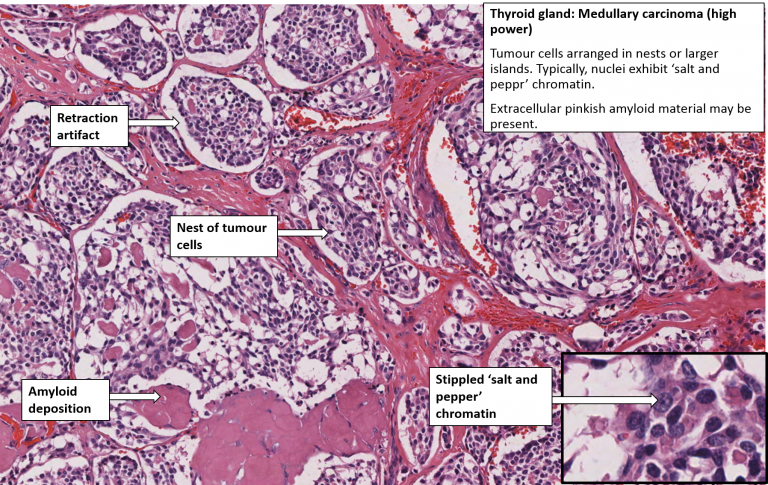 Thyroid – Medullary Carcinoma – Nus Pathweb :: Nus Pathweb