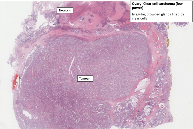 Ovary – Clear Cell Carcinoma – NUS Pathweb :: NUS Pathweb