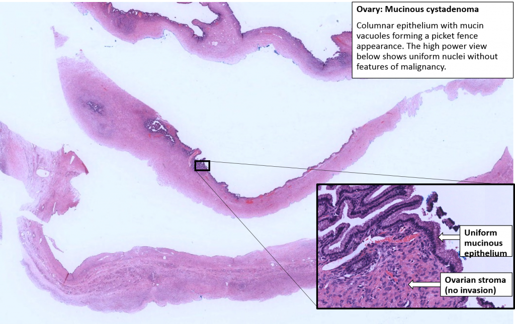 Ovary – Mucinous Cystadenoma – NUS Pathweb :: NUS Pathweb