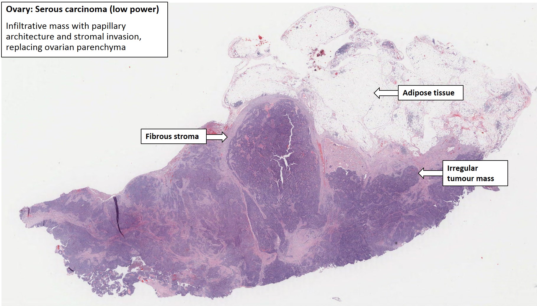 Serous Cystadenoma Ovary Histology