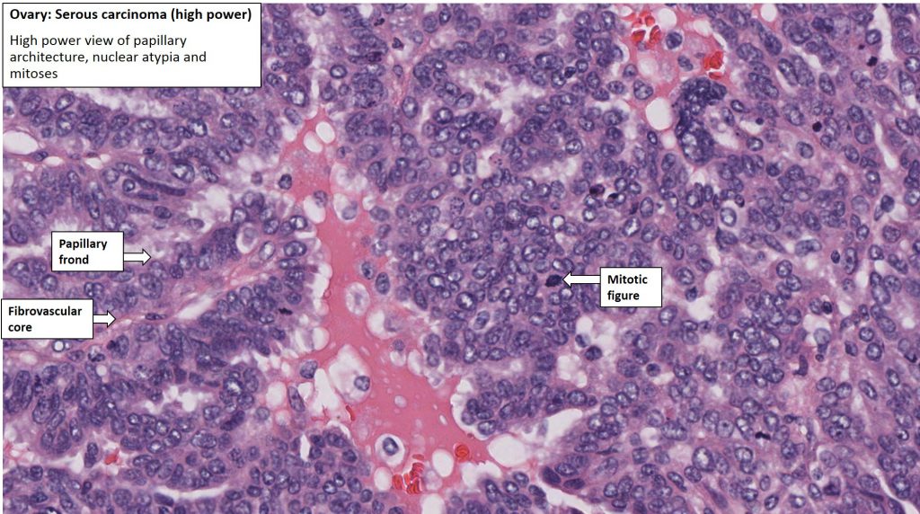 Ovary – Serous carcinoma – NUS Pathweb :: NUS Pathweb