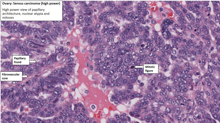 Ovary – Serous carcinoma (Serous cystadenocarcinoma) – NUS Pathweb ...