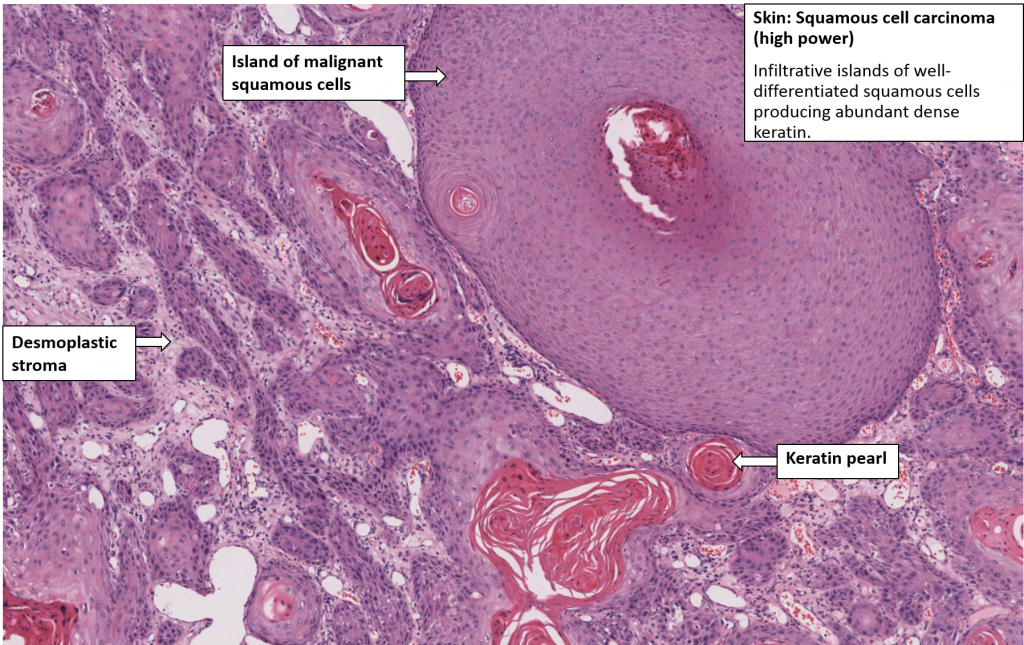 Skin – Squamous Cell Carcinoma – NUS Pathweb :: NUS Pathweb