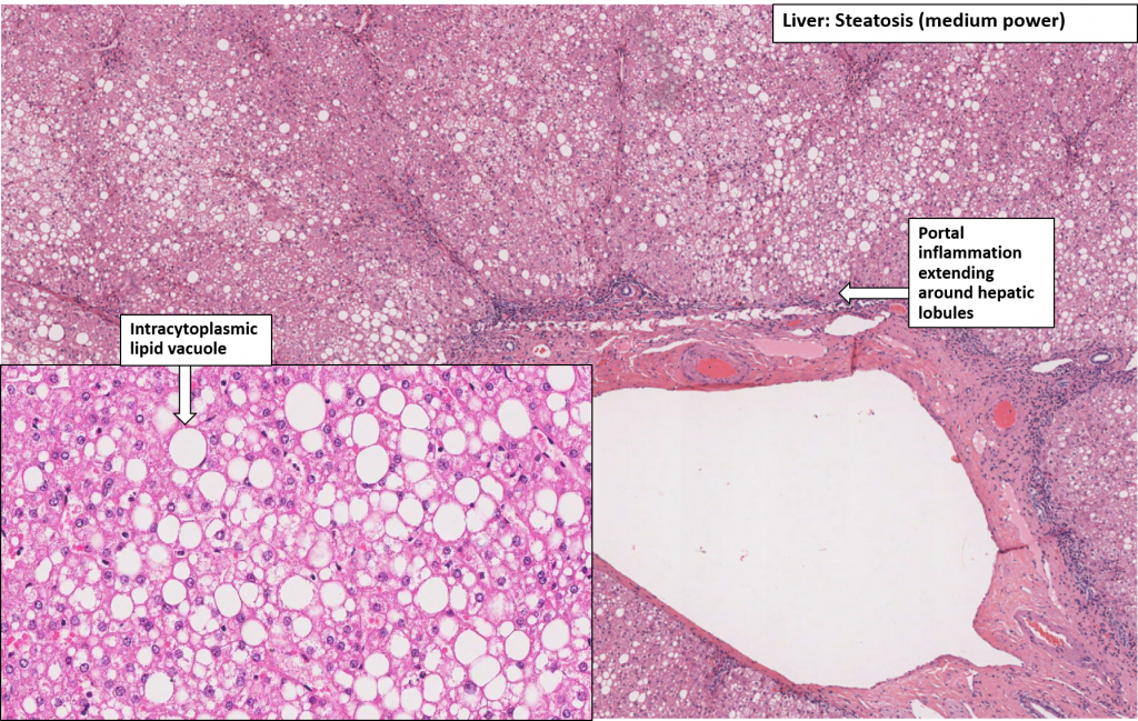 Liver – Fatty Change – NUS Pathweb :: NUS Pathweb