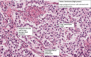 Testis – Seminoma – NUS Pathweb :: NUS Pathweb