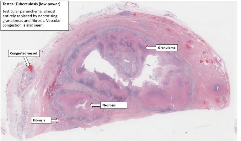 Testis – Tuberculous Epididymitis – NUS Pathweb :: NUS Pathweb